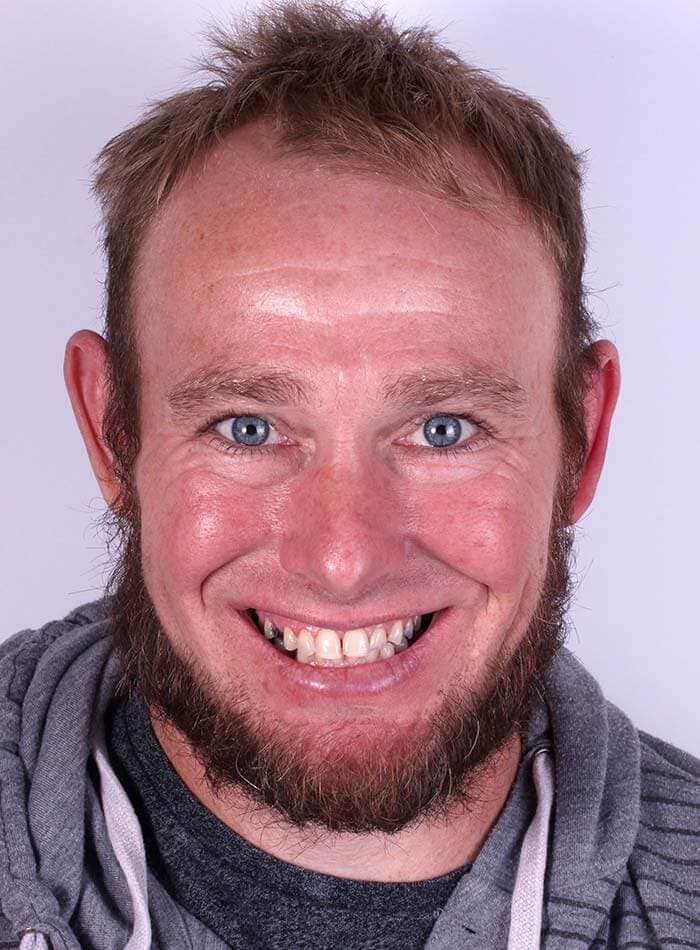 Smile Case 10 Before