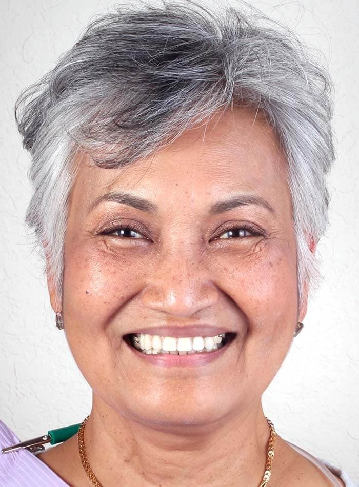 Smile Case 20 After