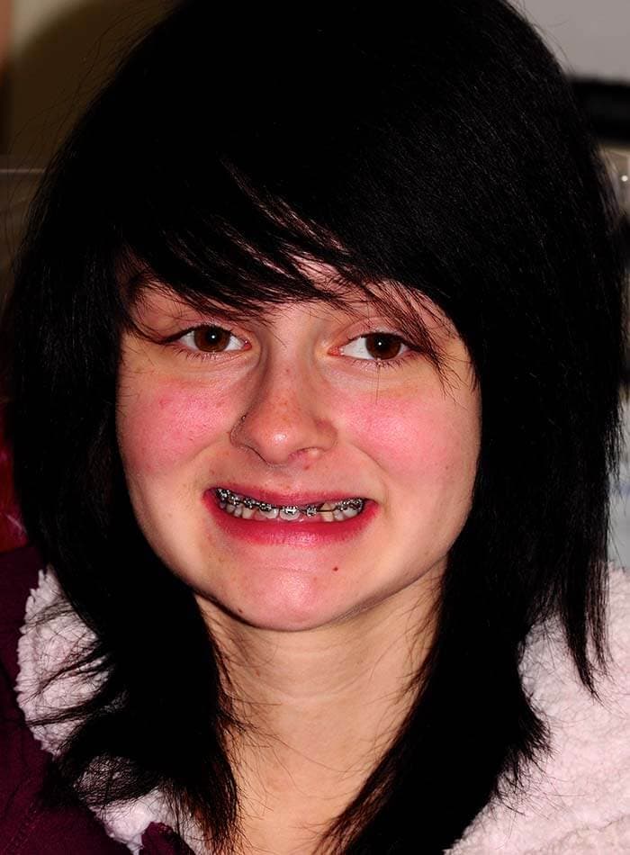 Smile Case 23 Before