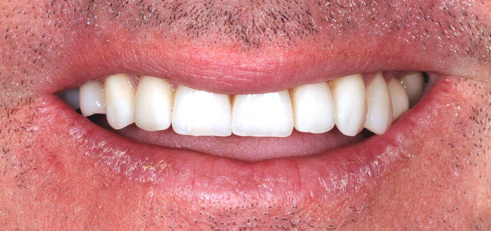 Smile Case 25 After