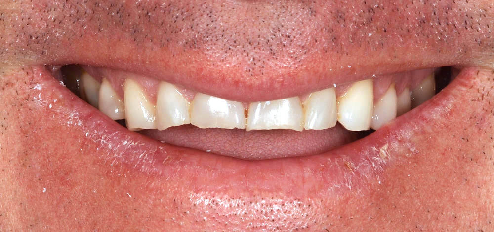 Smile Case 25 Before