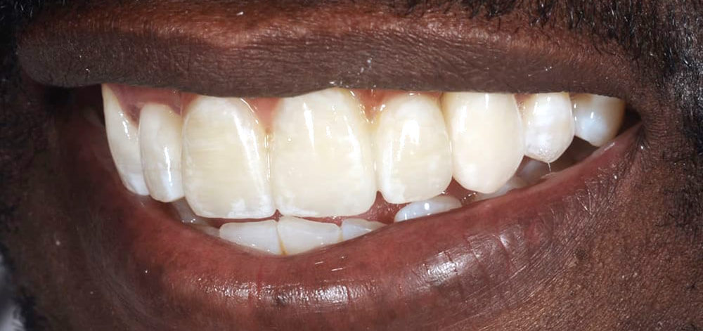 Smile Case 26 After