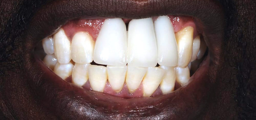 Smile Case 26 Before