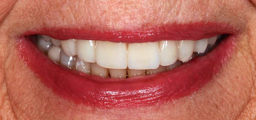 Smile Case 27 After