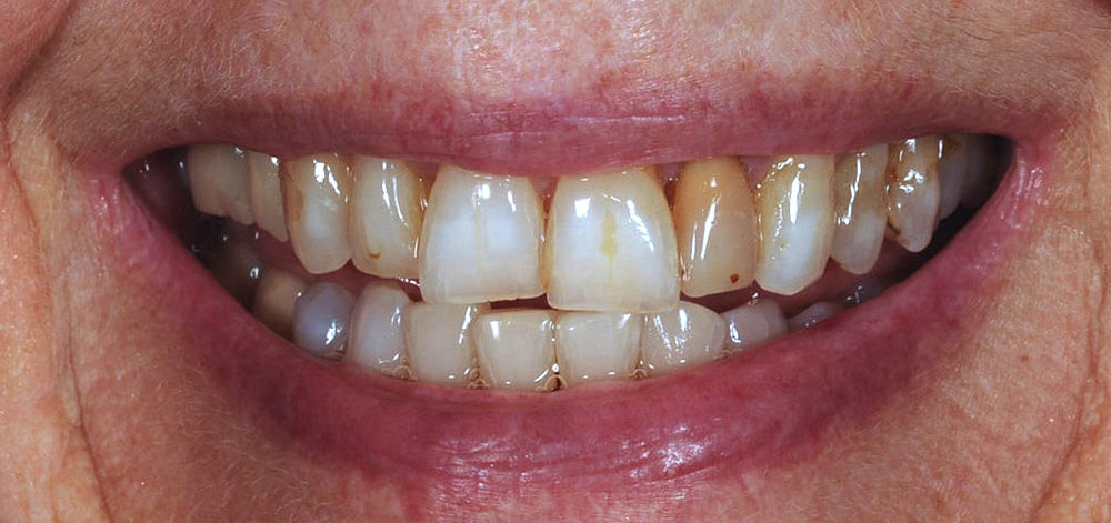 Smile Case 27 Before