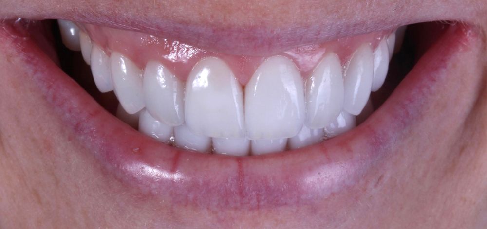 Smile Case 32 After