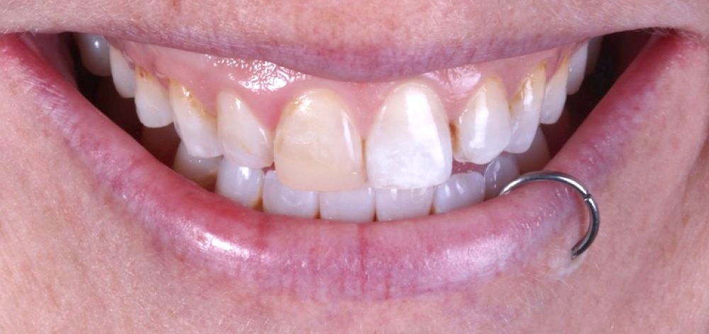 Smile Case 32 Before