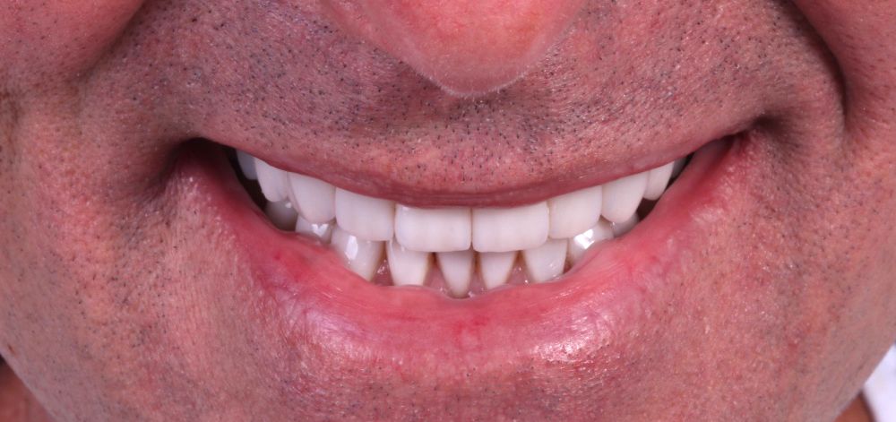Smile Case 33 After