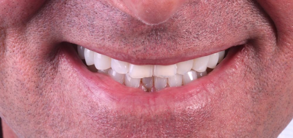 Smile Case 33 Before