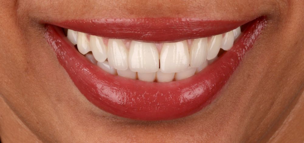 Smile Case 34 After