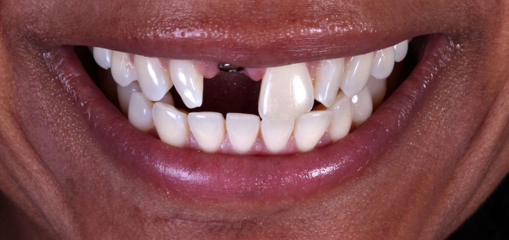 Smile Case 34 Before