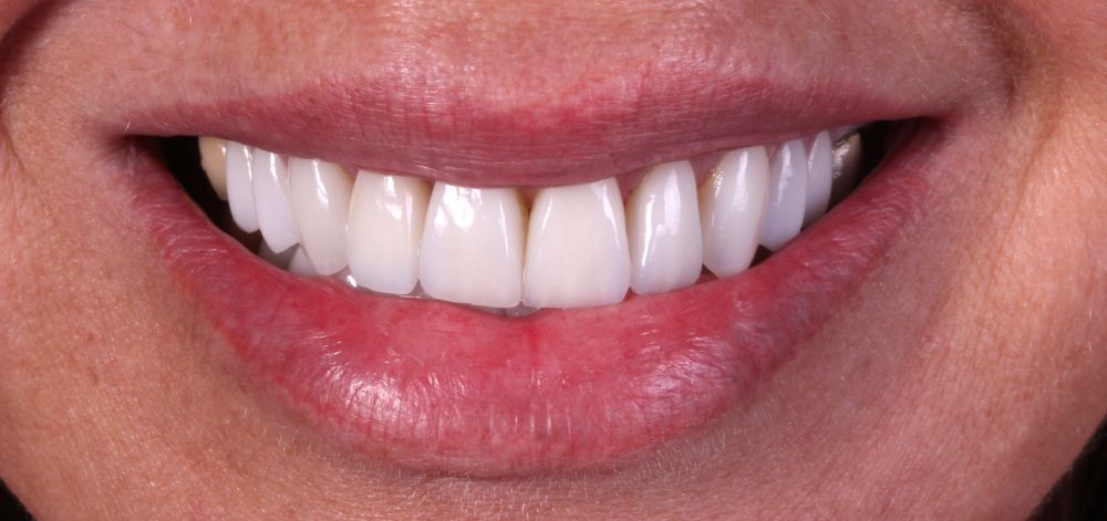 Smile Case 35 After