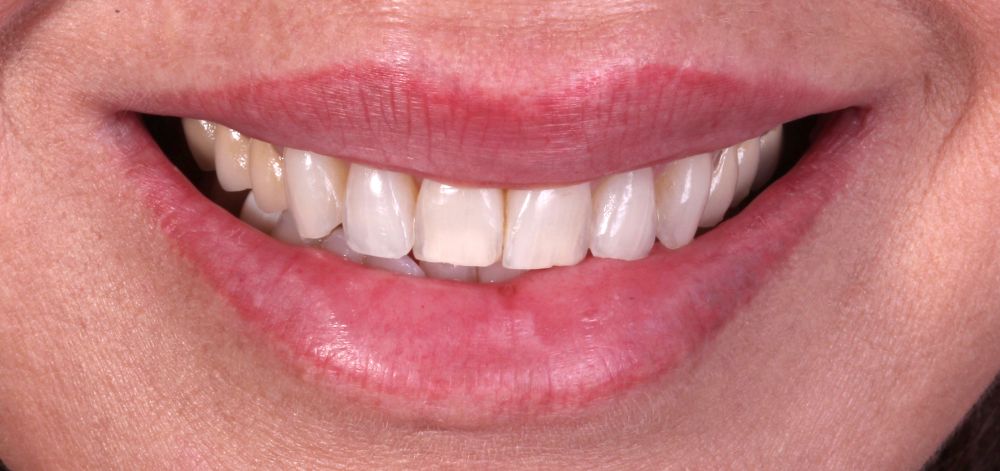Smile Case 35 Before