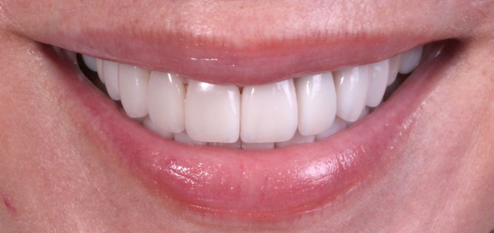 Smile Case 36 After