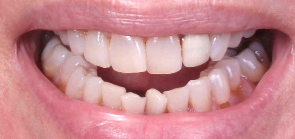 Smile Case 36 Before