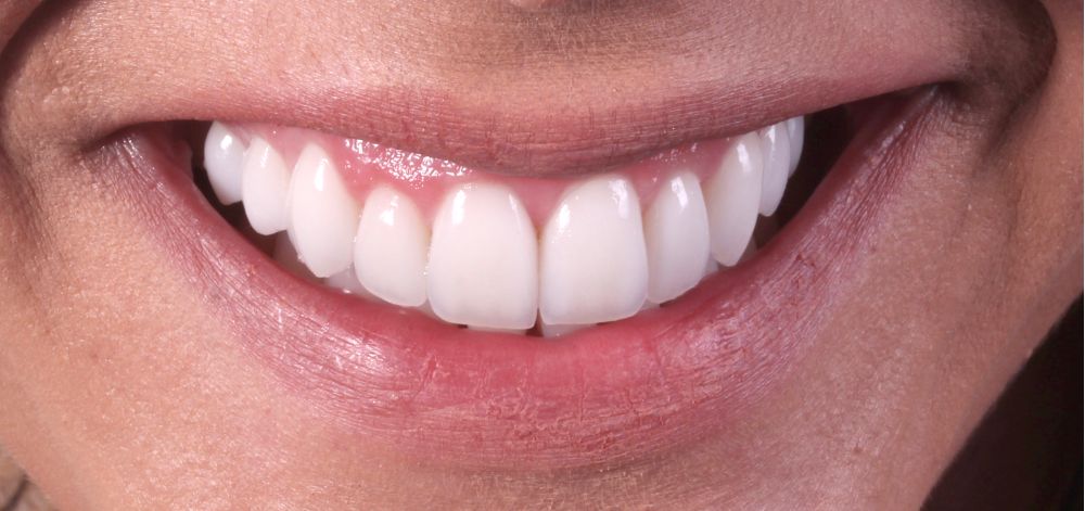 Smile Case 37 After