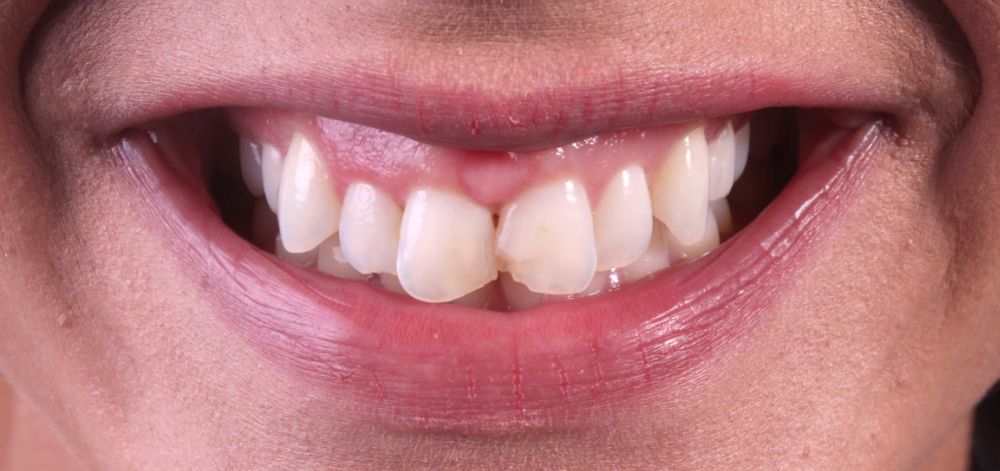 Smile Case 37 Before