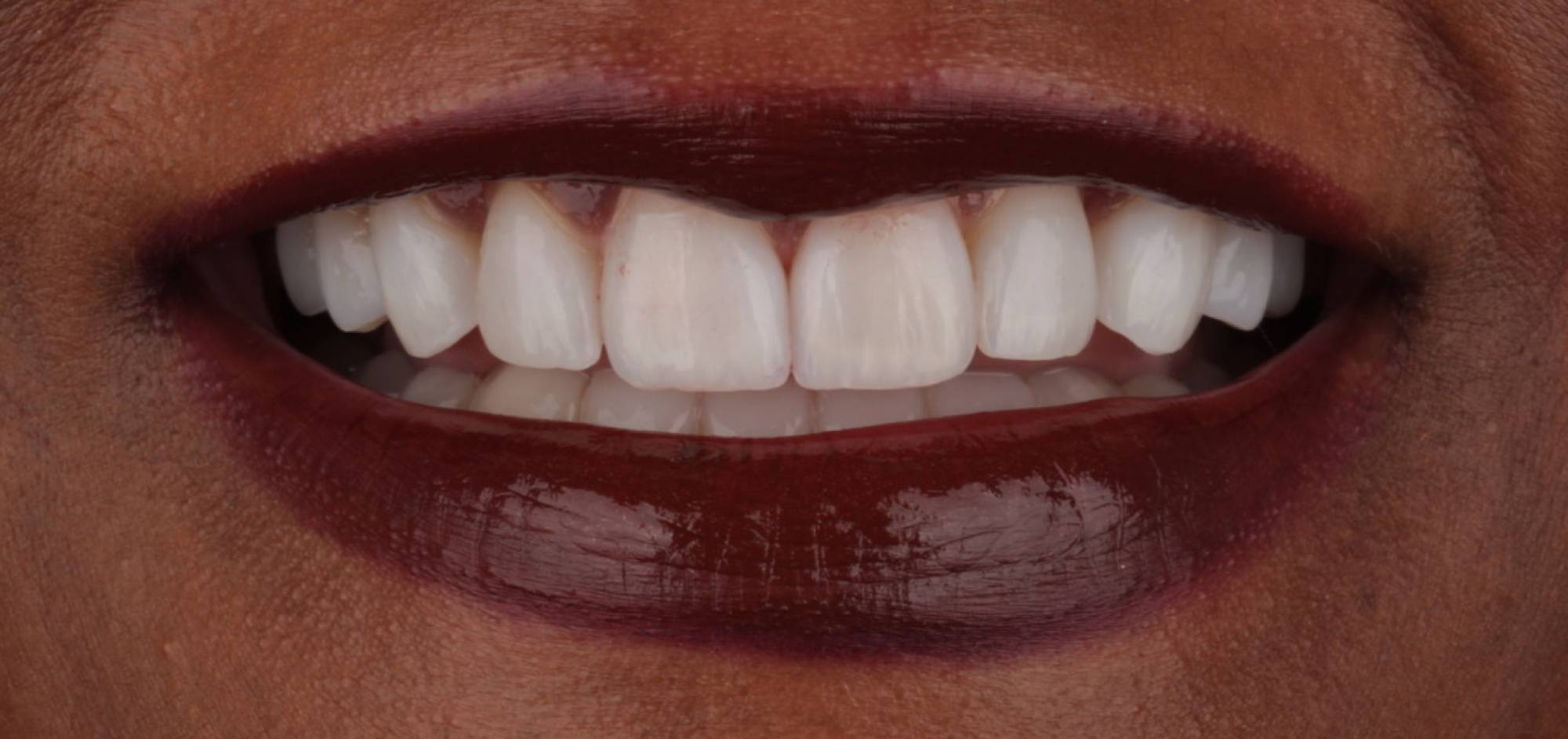 Smile Case 40 After