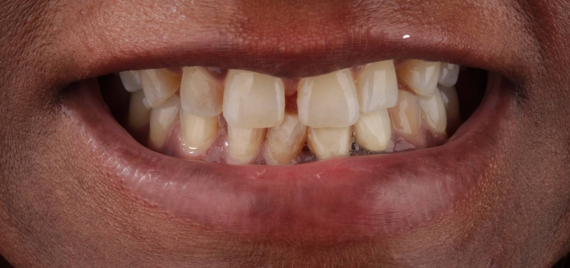 Smile Case 40 Before