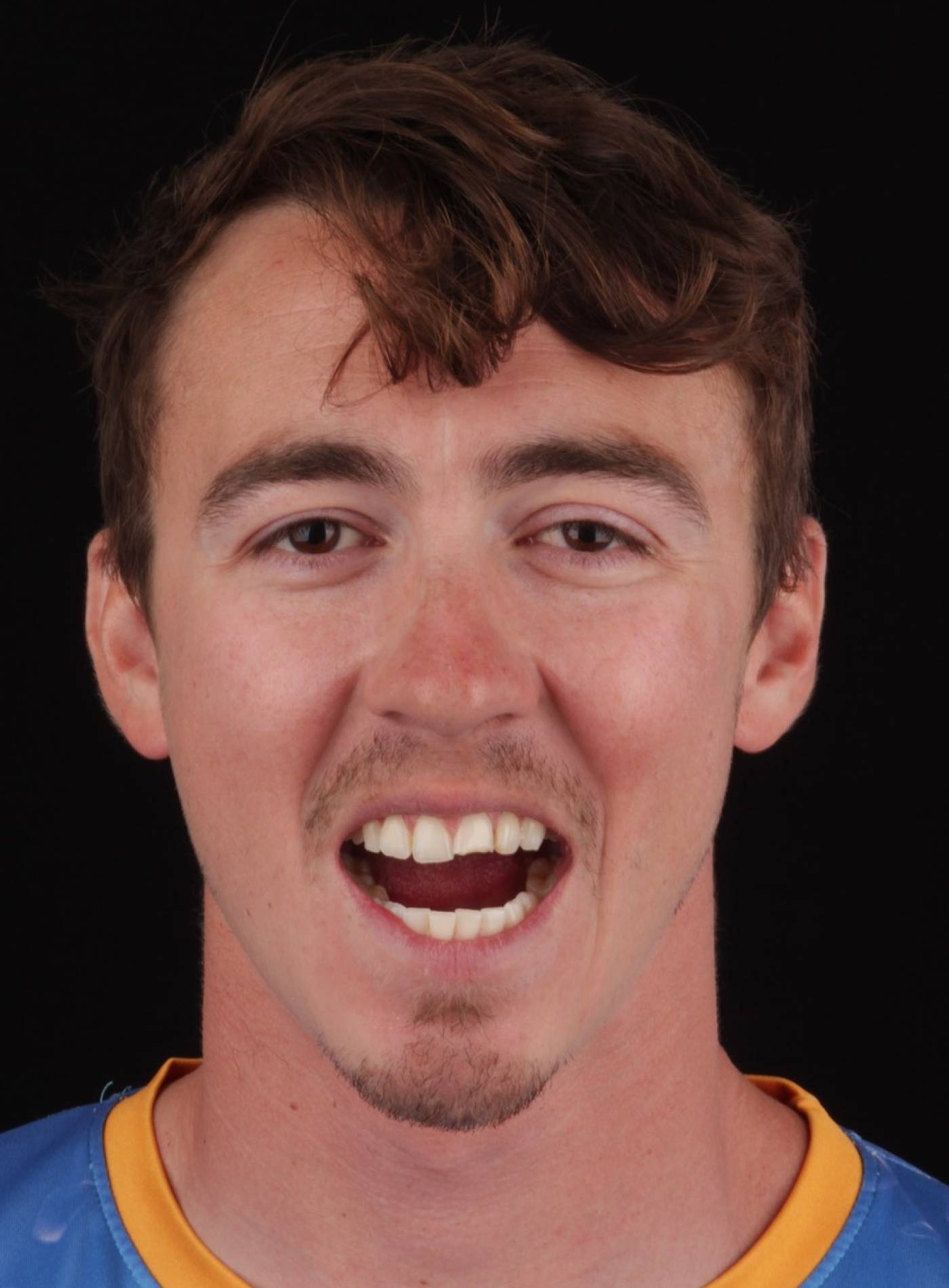 Smile Case 41 Before