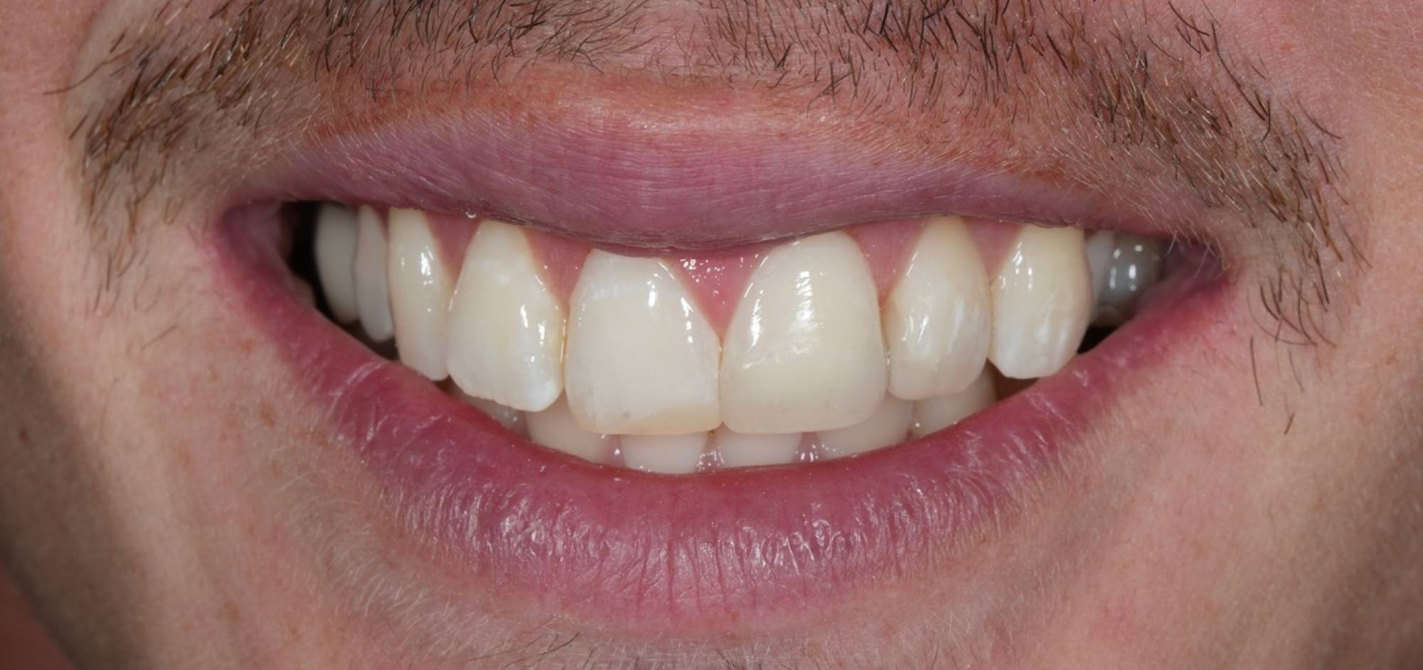 Smile Case 42 After