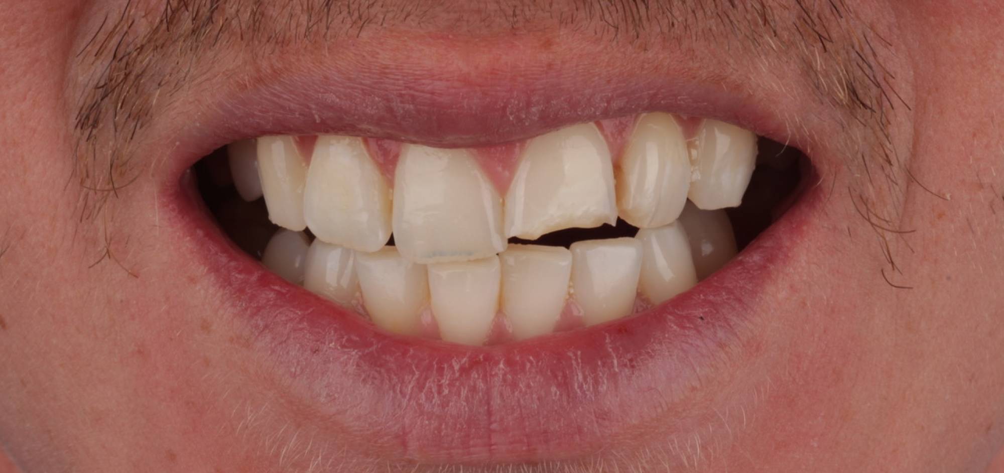 Smile Case 42 Before