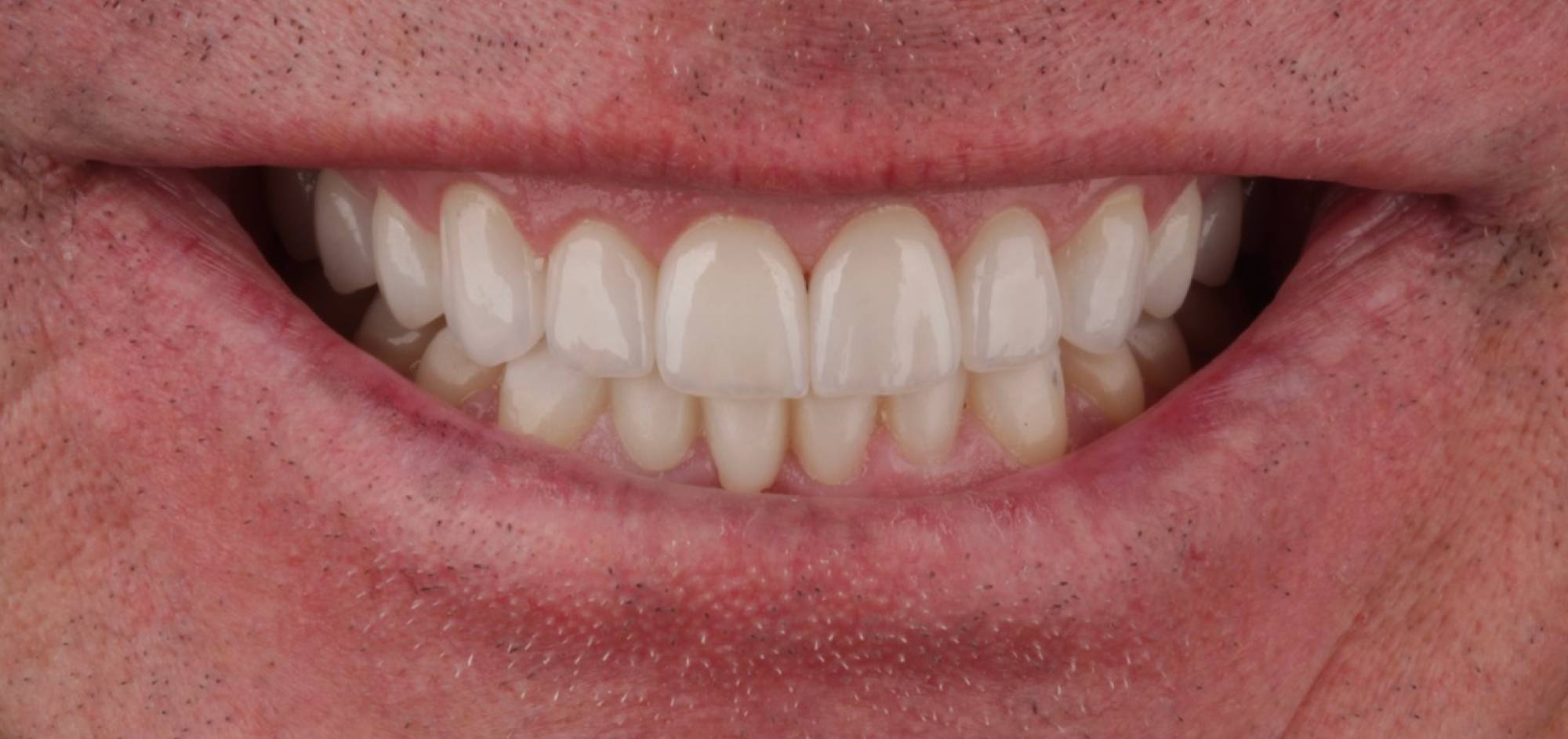 Smile Case 44 After