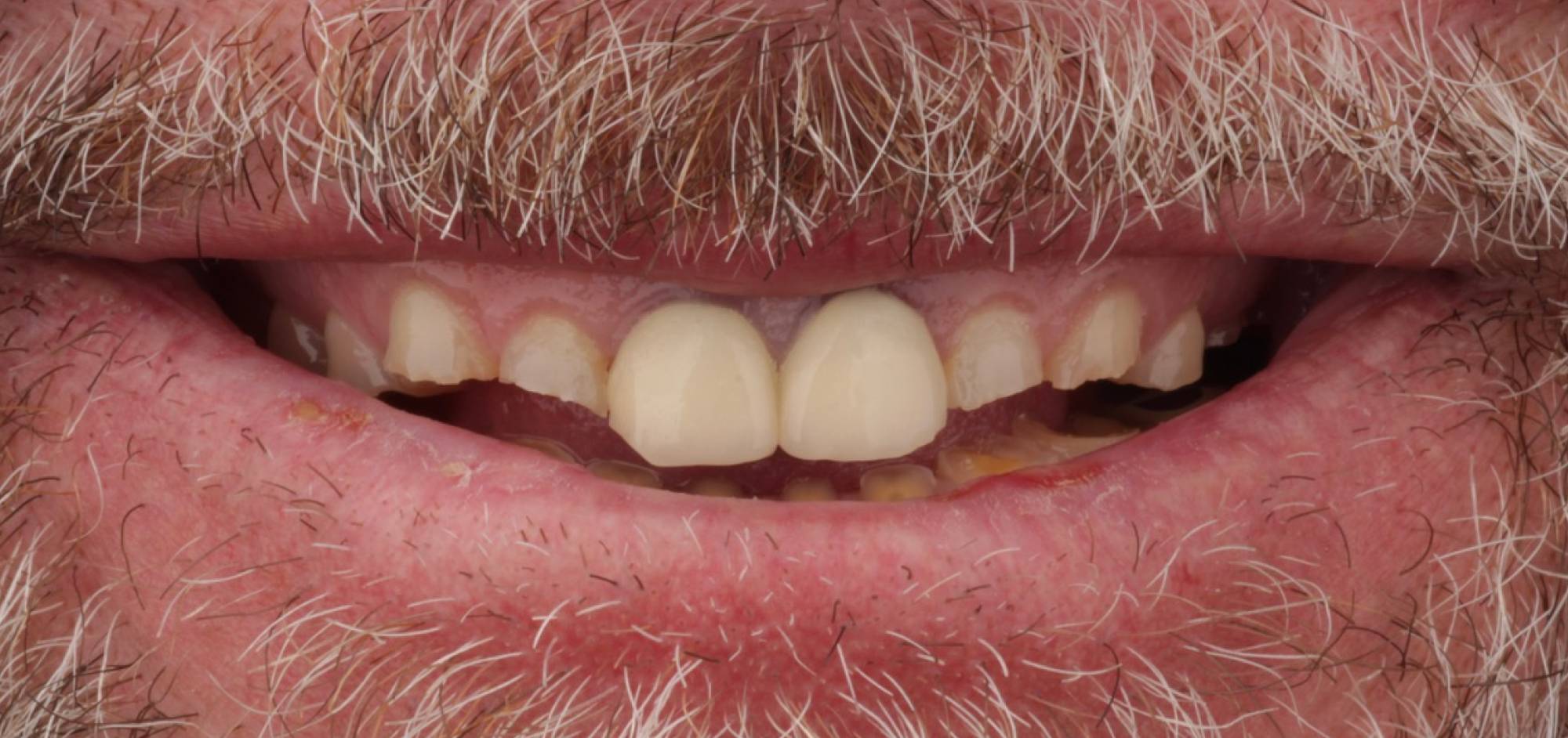Smile Case 44 Before