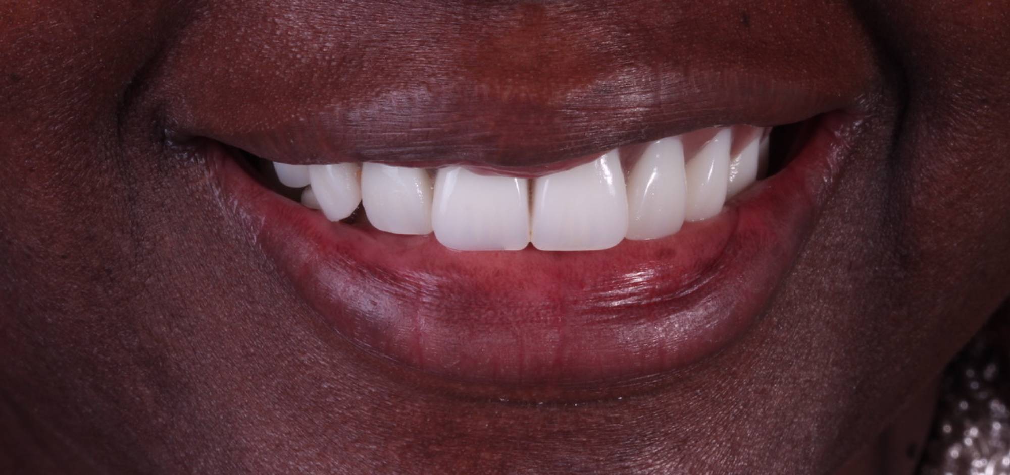 Smile Case 45 After