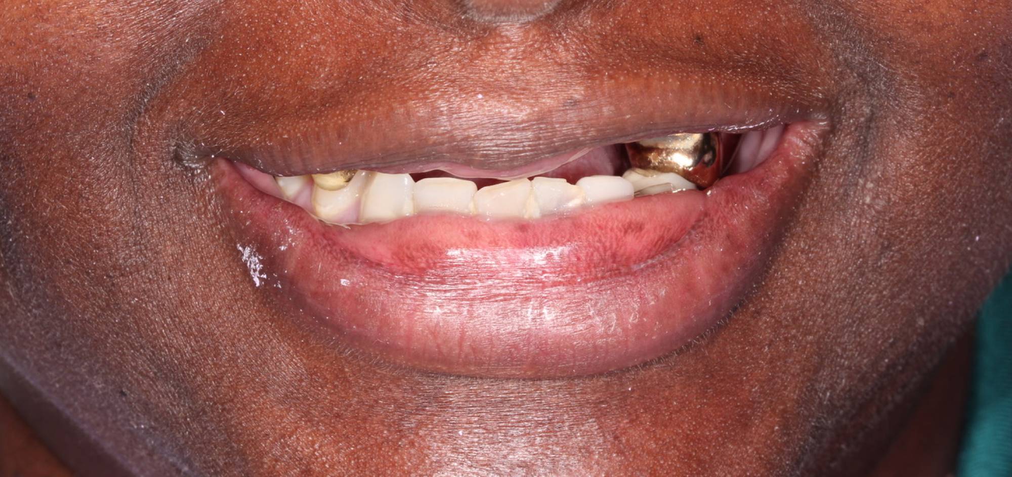Smile Case 45 Before