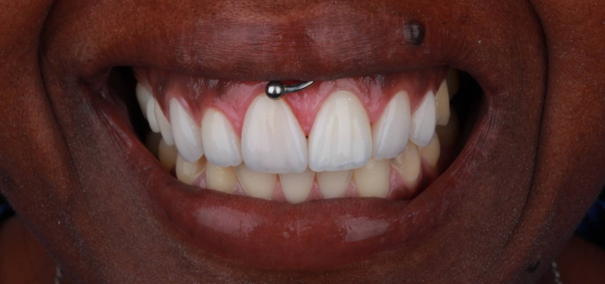Smile Case 46 After