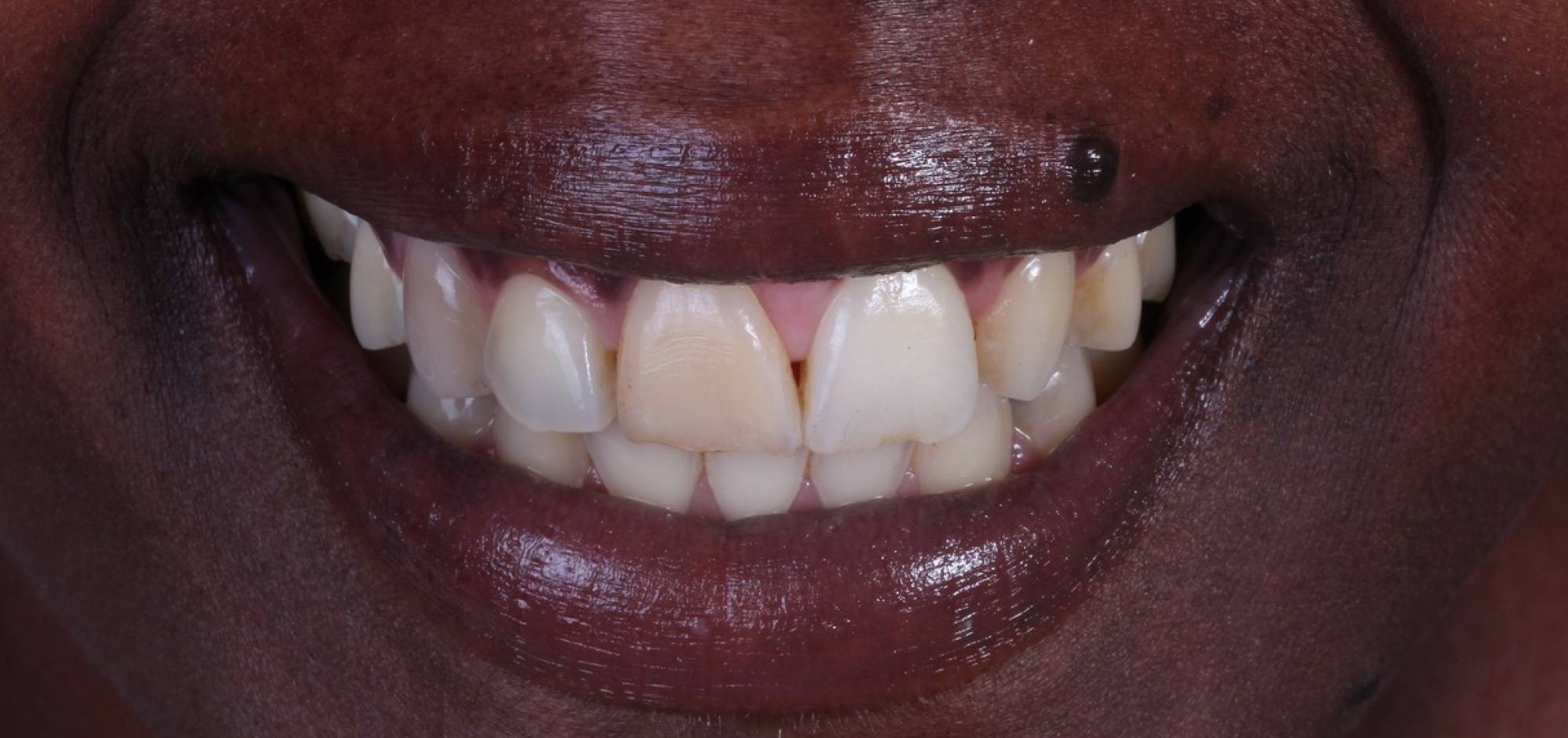 Smile Case 46 Before